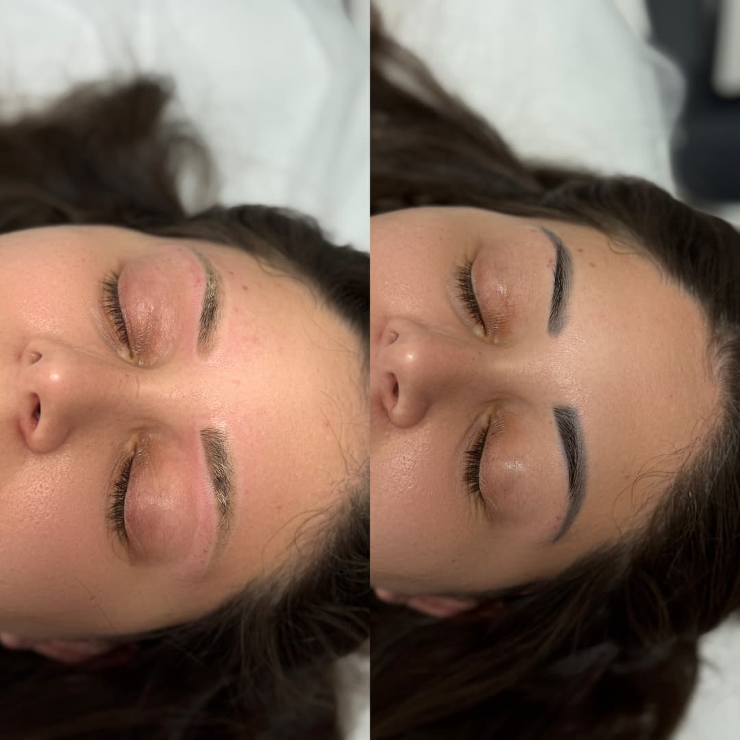 PMU Laser Removal